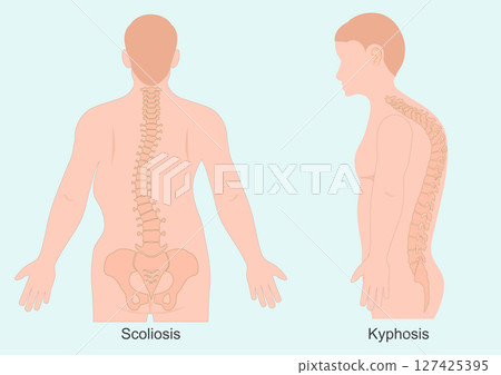 Kyphosis and scoliosis are both spinal conditions. Kyphosis and scoliosis are both spinal conditions. 127425395