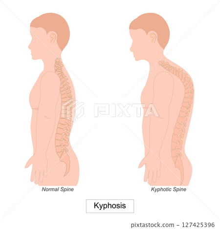 Kyphosis is an excessive forward curve of spine. Kyphosis is an excessive forward curve of spine. 127425396