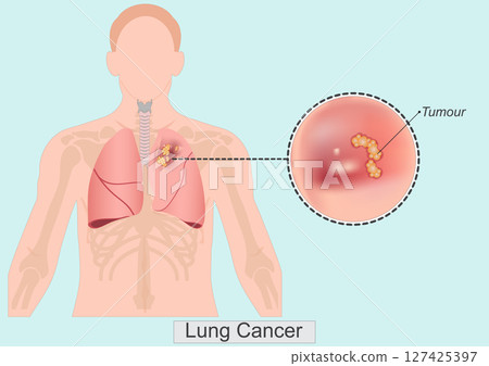 Lung cancer also known as lung carcinoma is a malignant tumor. 127425397