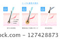 Needle hair removal procedure 127428873