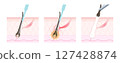 Needle hair removal procedure 127428874