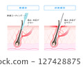 Needle hair removal: Difference between insulated and non-insulated needles 127428875