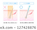 Benefits of needle hair removal: Hair removal is possible regardless of hair color 127428876