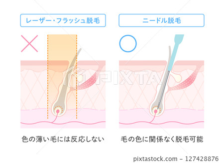 Benefits of needle hair removal: Hair removal is possible regardless of hair color Benefits of needle hair removal: Hair removal is possible regardless of hair color 127428876