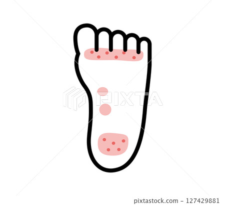 腳癬圖示插圖向量 腳癬圖示插圖向量 127429881