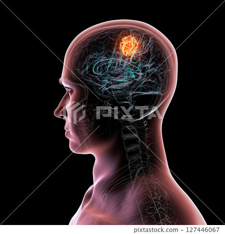 Brain tumor, 3D illustration. Meningioma, glioma, astrocytoma, and other brain tumors Brain tumor, 3D illustration. Meningioma, glioma, astrocytoma, and other brain tumors 127446067