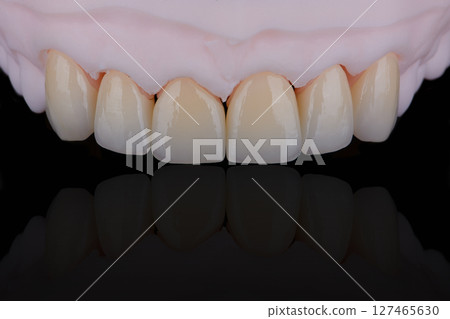 High-quality six dental crowns made of zirconium for fixation to the frontal teeth of upper jaw. High-quality six dental crowns made of zirconium for fixation to the frontal teeth of upper jaw. 127465630