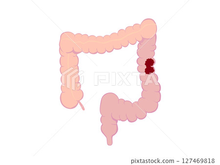 Colon cancer colon Colon cancer colon 127469818