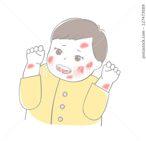 Baby eczema 127473089
