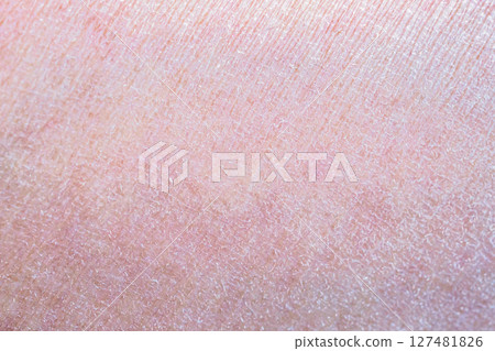 dry and dehydrated human skin texture background 127481826
