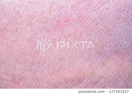 dry and dehydrated human skin texture background 127481827