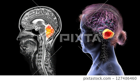Cerebellum, 3D illustration and colored MRI composite showing brain anatomy with highlighted cerebellum, important for coordination, balance, and motor control. Cerebellum, 3D illustration and colored MRI composite showing brain anatomy with highlighted cerebellum, important for coordination, balance, and motor control. 127486460