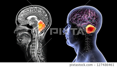 Cerebellum, 3D illustration and colored MRI composite showing brain anatomy with highlighted cerebellum, important for coordination, balance, and motor control. Cerebellum, 3D illustration and colored MRI composite showing brain anatomy with highlighted cerebellum, important for coordination, balance, and motor control. 127486461