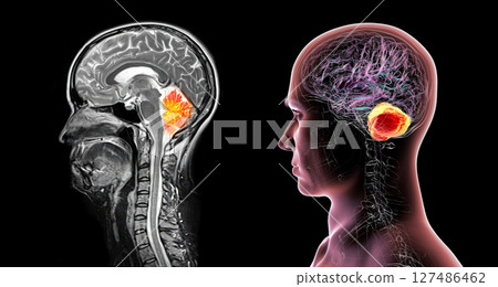 Cerebellum, 3D illustration and colored MRI composite showing brain anatomy with highlighted cerebellum, important for coordination, balance, and motor control. 127486462