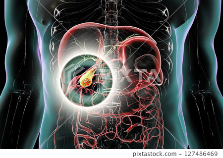 Gallbladder with stones, 3D illustration showing cholelithiasis. Gallstones can block bile flow and cause pain, inflammation, or infection requiring medical or surgical treatment. 127486469