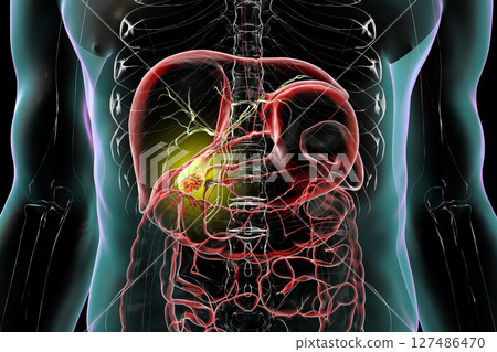 Gallbladder with stones, 3D illustration showing cholelithiasis. Gallstones can block bile flow and cause pain, inflammation, or infection requiring medical or surgical treatment. 127486470