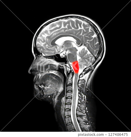 Medulla oblongata highlighted in human brain, colored composite MRI image. Controls breathing, heartbeat, and other vital autonomic functions Medulla oblongata highlighted in human brain, colored composite MRI image. Controls breathing, heartbeat, and other vital autonomic functions 127486475