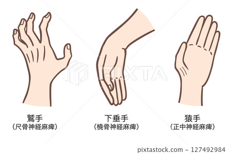 Claw hand, drop hand, monkey hand, hand deformity due to nerve paralysis of the upper limbs 127492984