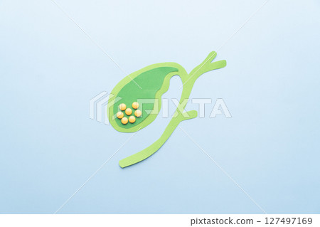 Gallbladder with gallstones (cholelithiasis) anatomy made from paper on blue background. Gallstone blocks the flow of bile through your biliary system causing cholecystitis, pancreatitis, cholangitis. 127497169