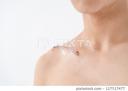 傷口、損傷、縫合、疤痕 127517477