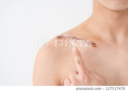 傷口、損傷、縫合、疤痕 127517478