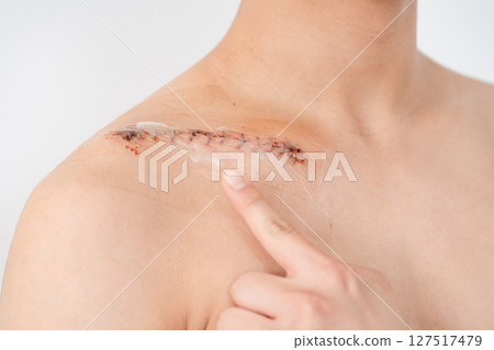 傷口、損傷、縫合、疤痕 傷口、損傷、縫合、疤痕 127517479