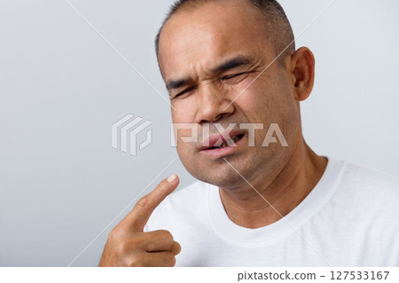 Man has facial swelling due to an allergic reaction to triggers such as insect bites, food Man has facial swelling due to an allergic reaction to triggers such as insect bites, food 127533167