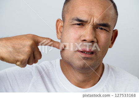 Man has facial swelling due to an allergic reaction to triggers such as insect bites, food Man has facial swelling due to an allergic reaction to triggers such as insect bites, food 127533168