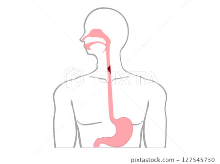 Esophageal cancer inside the human body Esophageal cancer inside the human body 127545730