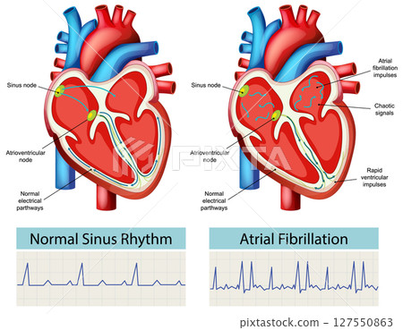 Heart Rhythm Comparison: Normal vs Atrial Fibrillation 127550863