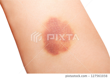 Female leg well-groomed with hematoma close-up on inner surface of thigh isolated on white background with clipping path Female leg well-groomed with hematoma close-up on inner surface of thigh isolated on white background with clipping path 127561038