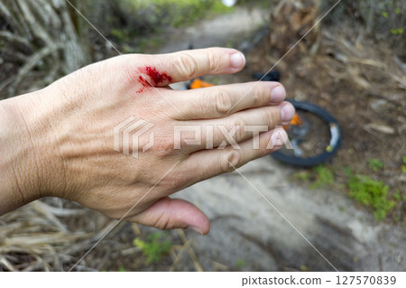 Arm injury while riding mountain bike on Florida jungle trails. Red bloody wound from hitting a tree stump. Biking accident 127570839
