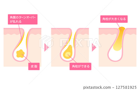 Cross-section of a pore clogged with keratin plugs Cross-section of a pore clogged with keratin plugs 127581925