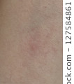 Skin, eczema, close-up 127584861