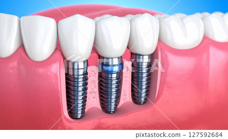 Implant image 127592684