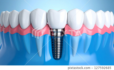 Implant image 127592685
