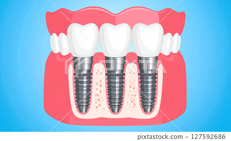 Implant image 127592686