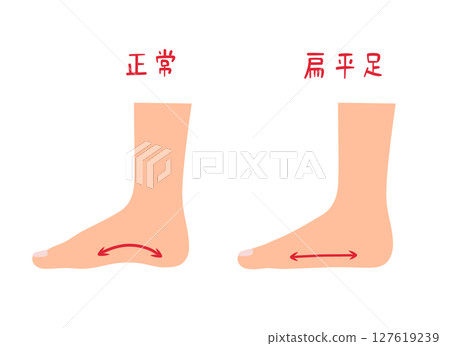 扁平足和正常足的插圖集 127619239