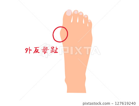 無主線拇趾外翻圖解 127619240