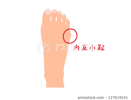 無主線拇趾外翻圖解 127619241