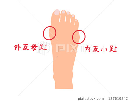 拇趾外翻和小趾內翻無主線的簡單圖示 127619242