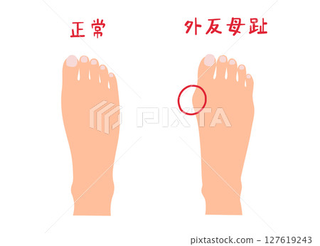 Bunion and normal foot simple illustration set without main lines 127619243