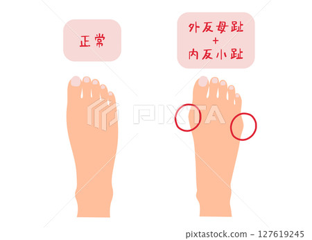 拇外翻、拇囊炎和正常足部無主線的簡單圖示 127619245