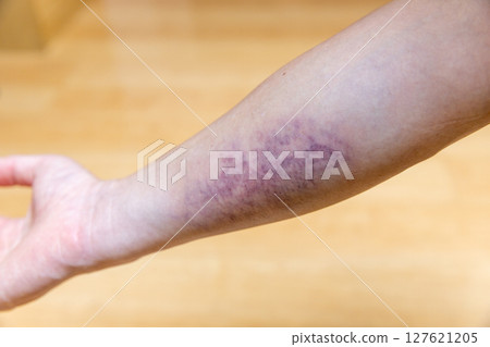 Blue bruise on right arm Blue bruise on right arm 127621205