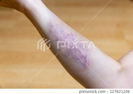 Blue bruise on right arm Blue bruise on right arm 127621206