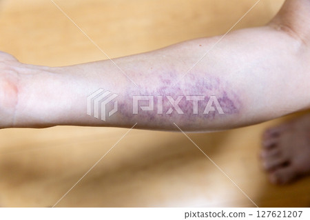 Blue bruise on right arm Blue bruise on right arm 127621207