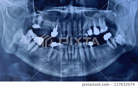 Close-up of image panoramic x-ray of teeth and jaw human 127632074