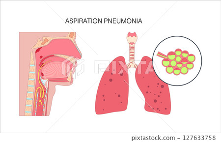 Aspiration pneumonia infection Aspiration pneumonia infection 127633758