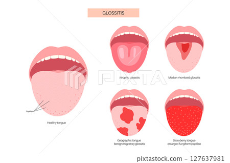 Tongue disease poster 127637981