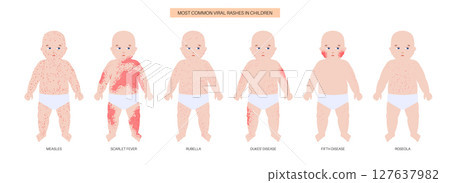 The most common viral rashes 127637982